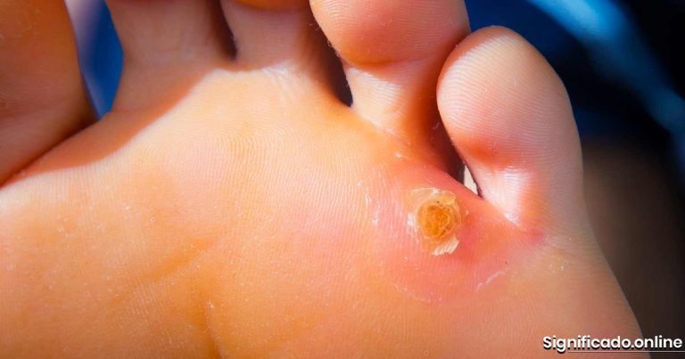 Papiloma o verruga plantar